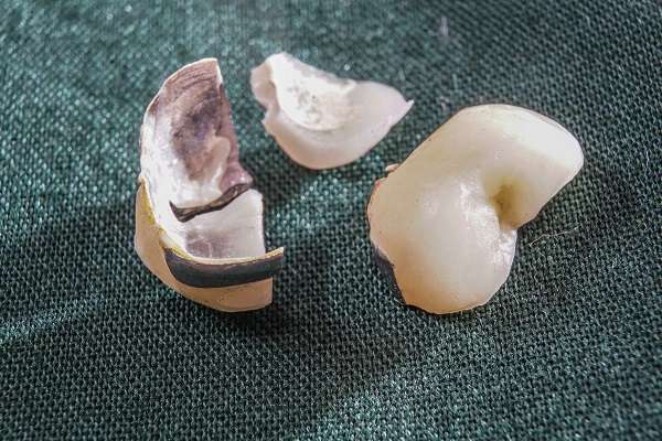 A Dental Veneer &# ; Solution For A Broken Tooth