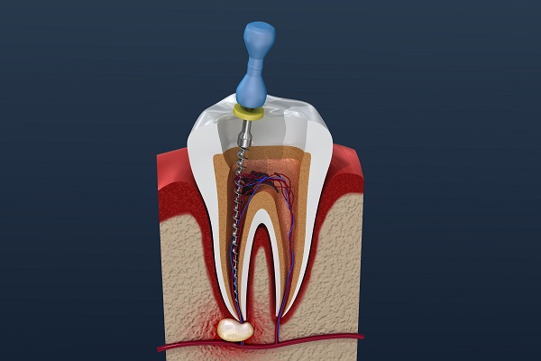 When Is A Root Canal Recommended?